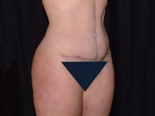 Tummy Tuck  Before & After Image