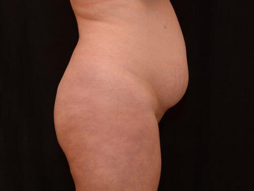 Tummy Tuck  Before & After Image