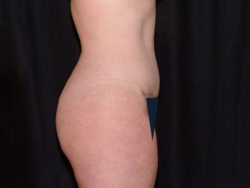 Tummy Tuck  Before & After Image