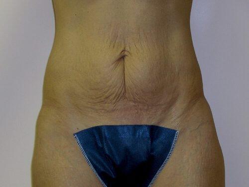 Tummy Tuck  Before & After Image