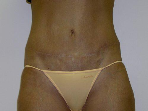 Tummy Tuck  Before & After Image