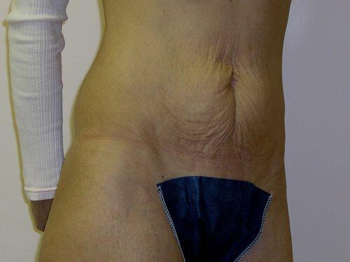 Tummy Tuck  Before & After Image