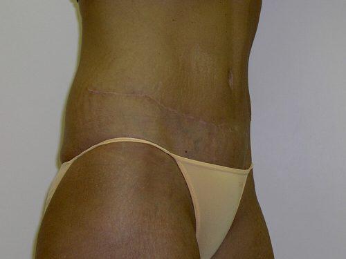 Tummy Tuck  Before & After Image