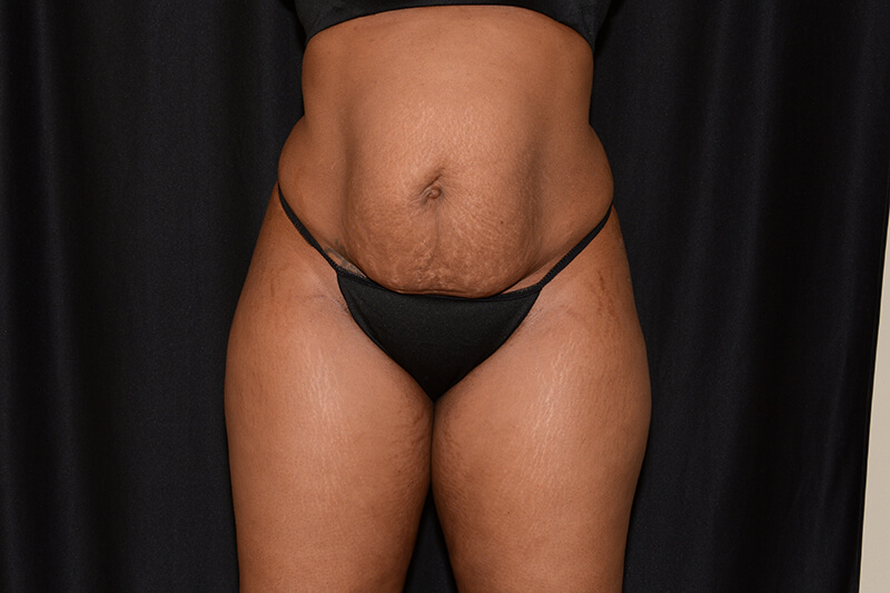 Tummy Tuck  Before & After Image