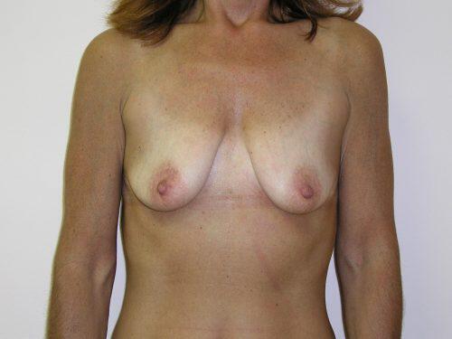 Breast Augmentation With Lift  Before & After Image