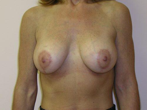 Breast Augmentation With Lift  Before & After Image