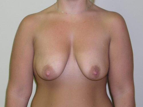 Breast Augmentation With Lift  Before & After Image