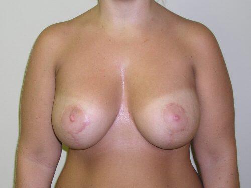 Breast Augmentation With Lift  Before & After Image