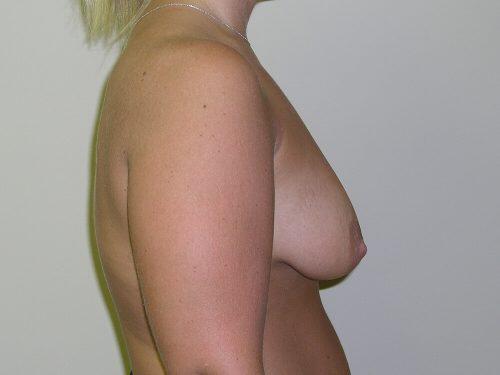 Breast Augmentation With Lift  Before & After Image