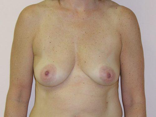 Breast Augmentation With Lift  Before & After Image