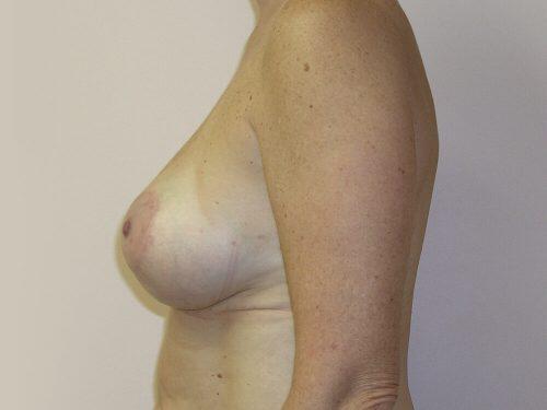 Breast Augmentation With Lift  Before & After Image