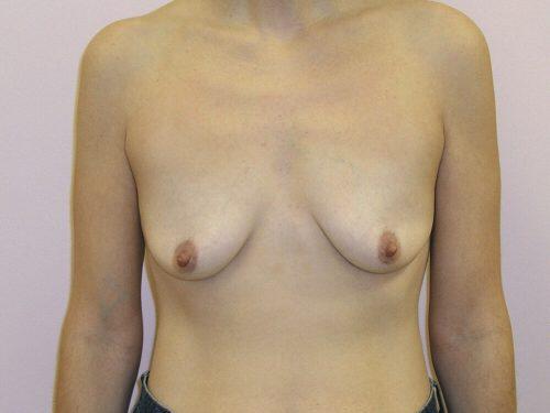 Breast Augmentation With Lift  Before & After Image