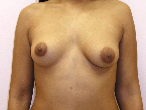 Breast Augmentation With Lift  Before & After Image