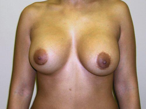 Breast Augmentation With Lift  Before & After Image