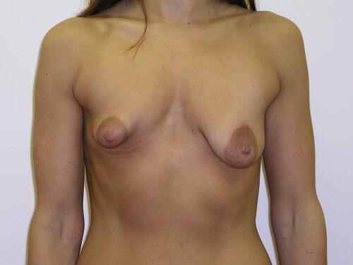 Breast Augmentation With Lift  Before & After Image