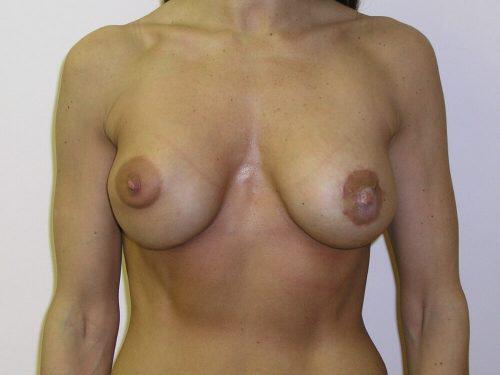 Breast Augmentation With Lift  Before & After Image