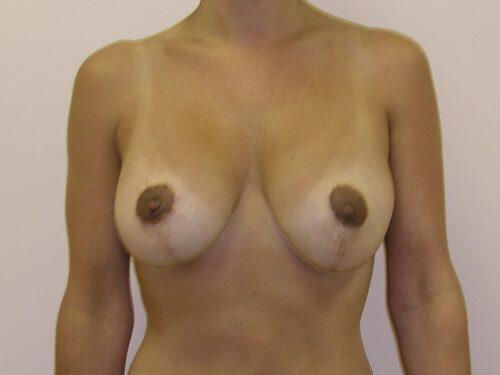 Breast Augmentation With Lift  Before & After Image