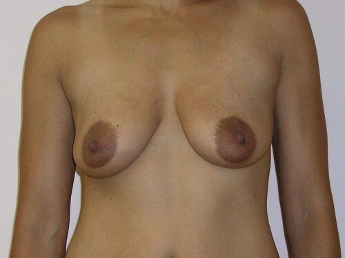 Breast Augmentation With Lift  Before & After Image