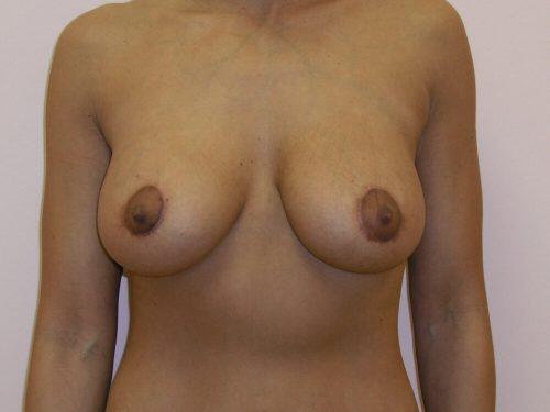 Breast Augmentation With Lift  Before & After Image