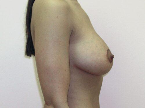 Breast Augmentation With Lift  Before & After Image