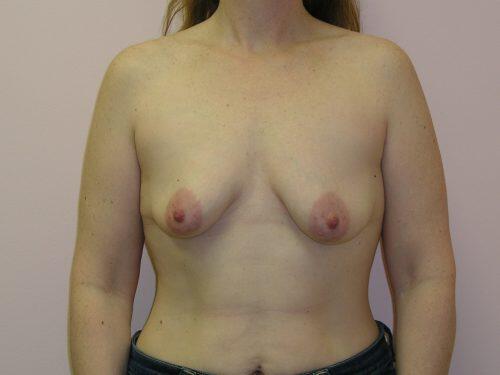 Breast Augmentation With Lift  Before & After Image