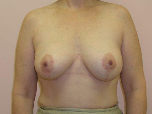 Breast Augmentation With Lift  Before & After Image