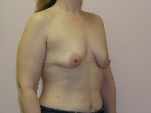 Breast Augmentation With Lift  Before & After Image