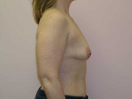 Breast Augmentation With Lift  Before & After Image