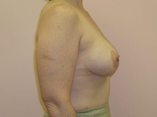 Breast Augmentation With Lift  Before & After Image