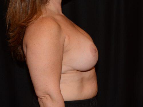 Breast Augmentation With Lift  Before & After Image