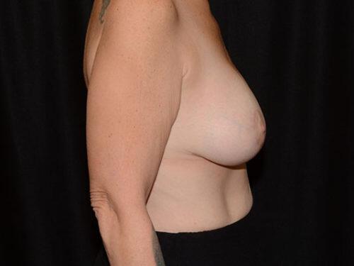 Breast Augmentation With Lift  Before & After Image