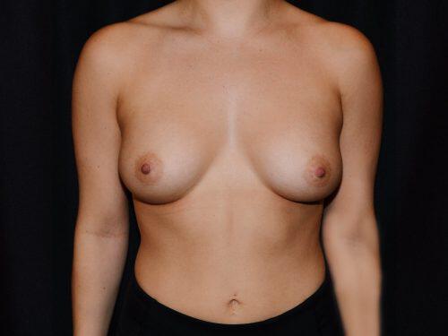 Breast Augmentation  Before & After Image