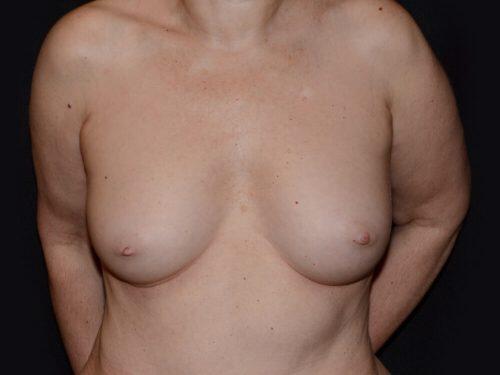 Breast Augmentation  Before & After Image