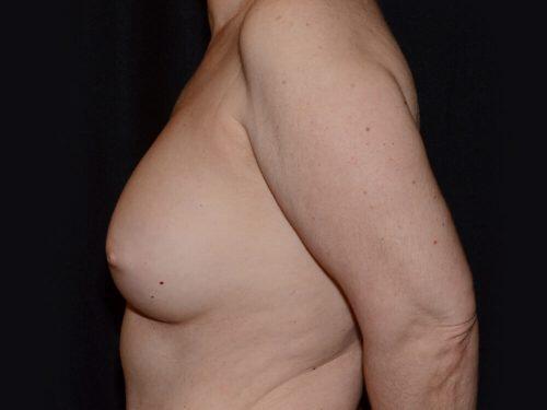 Breast Augmentation  Before & After Image