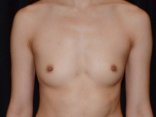 Breast Augmentation  Before & After Image