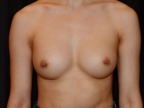 Breast Augmentation  Before & After Image