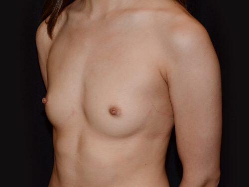 Breast Augmentation  Before & After Image