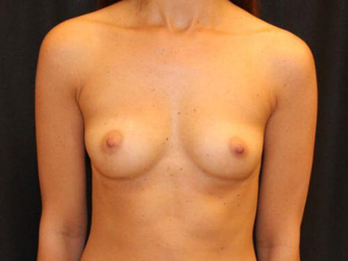 Breast Augmentation  Before & After Image