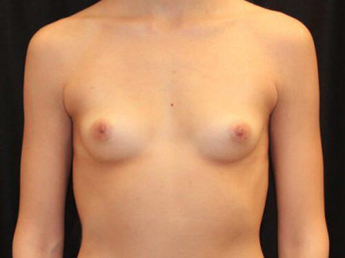 Breast Augmentation  Before & After Image