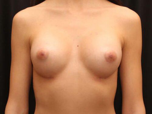 Breast Augmentation  Before & After Image