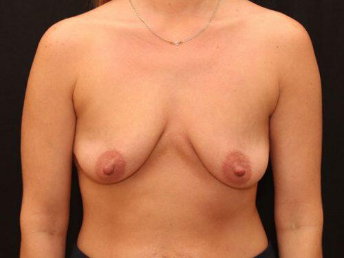 Breast Augmentation  Before & After Image