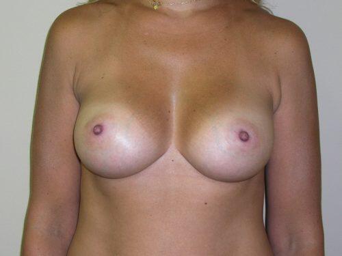 Breast Augmentation  Before & After Image