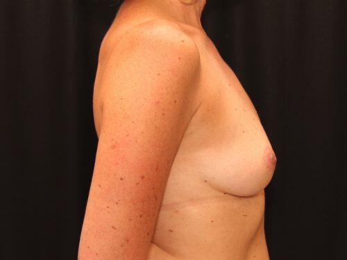 Breast Augmentation  Before & After Image