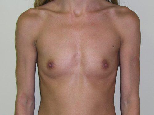 Breast Augmentation  Before & After Image