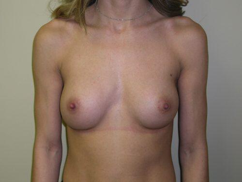 Breast Augmentation  Before & After Image