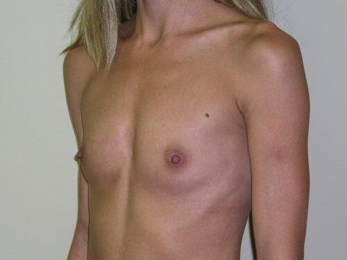 Breast Augmentation  Before & After Image