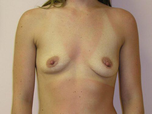 Breast Augmentation  Before & After Image