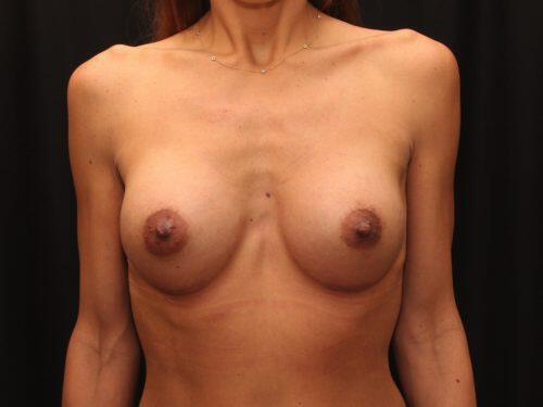 Breast Augmentation  Before & After Image