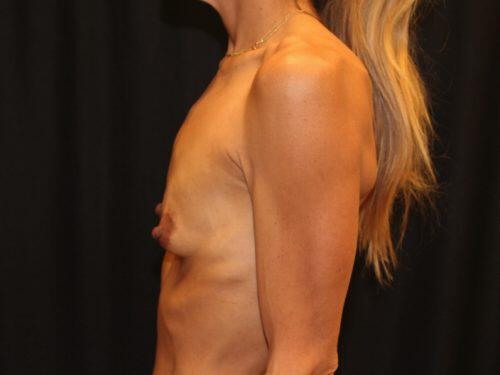 Breast Augmentation  Before & After Image