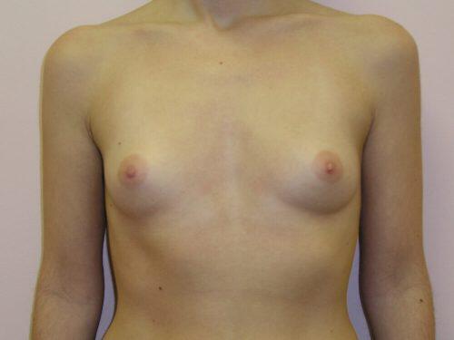 Breast Augmentation  Before & After Image